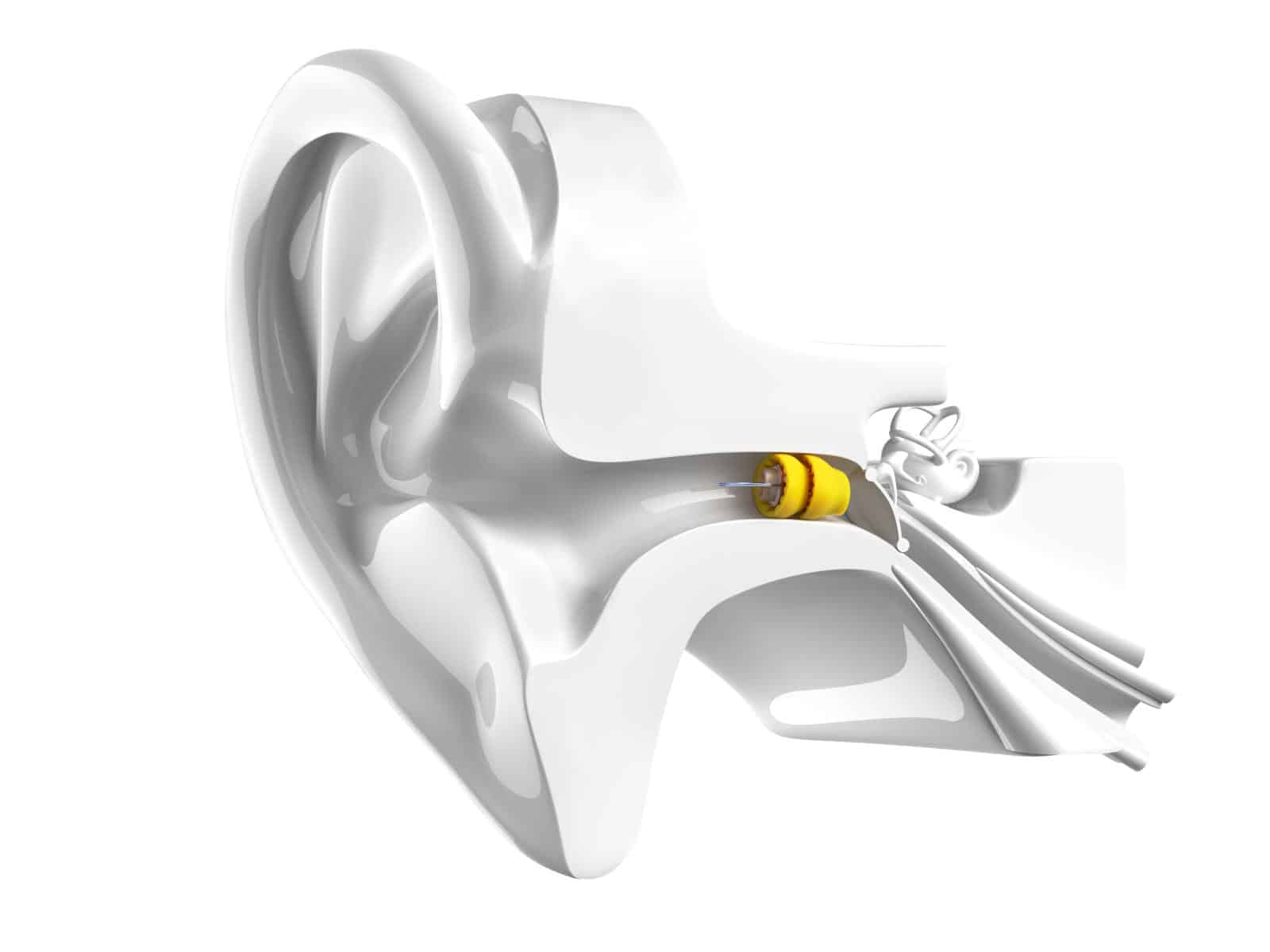 Phonak Lyric im Gehörgang – so funktioniert das unsichtbare Hörgerät